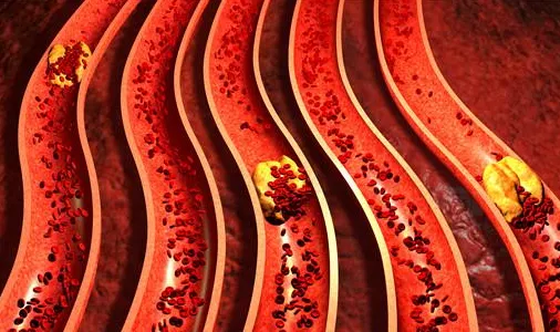 血管 “高凝” 怕血栓?2 种食材防凝结,日常吃超安心!